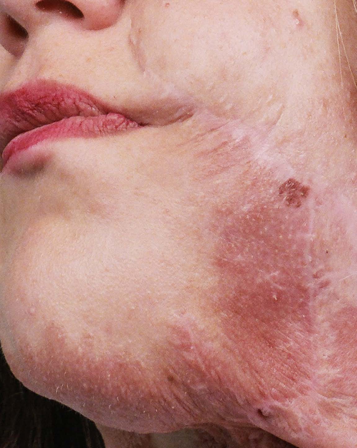 Détail d’une cicatrice sur un visage