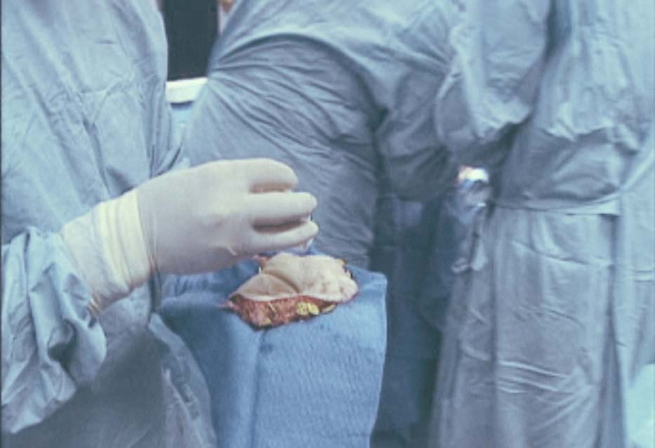 Greffon facial tenu selon le protocole chirurgical