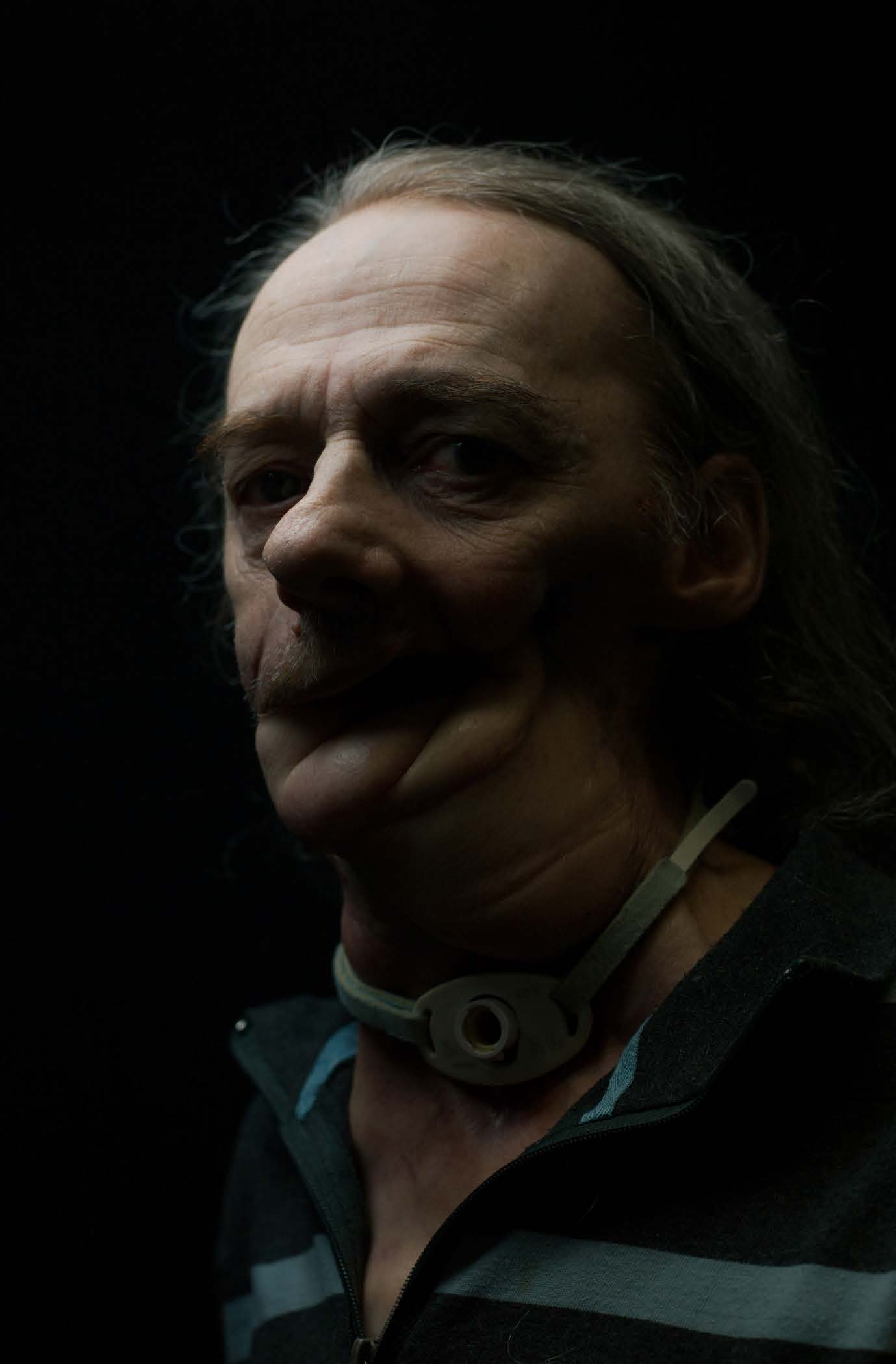 Portrait frontal avec une trachéotomie