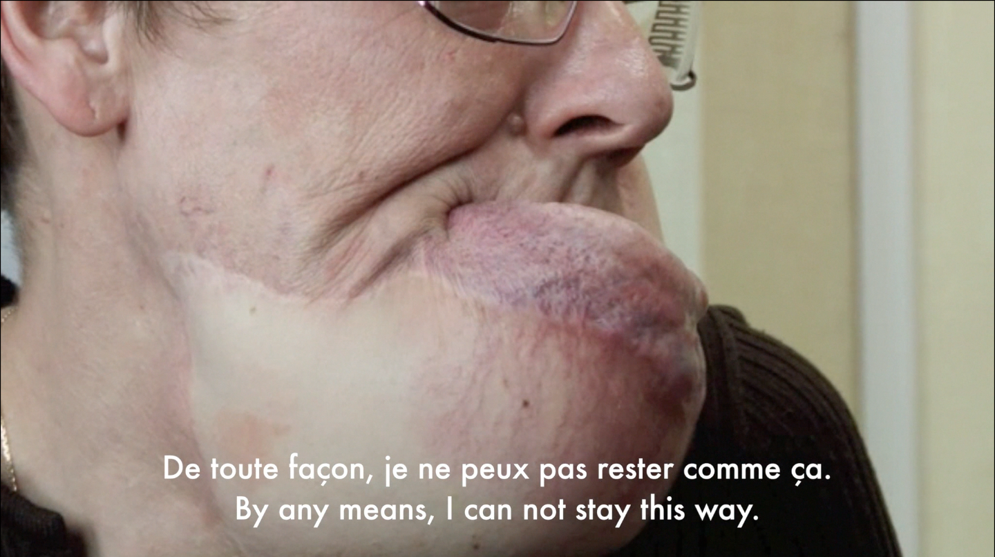 Mme B. s’exprimant avant son allotransplantation faciale